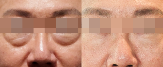 눈가 전후 02