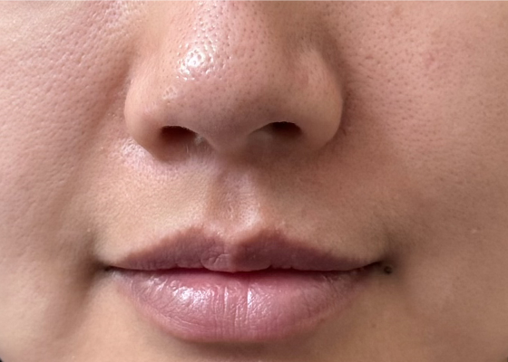 눈매주름 시술 전