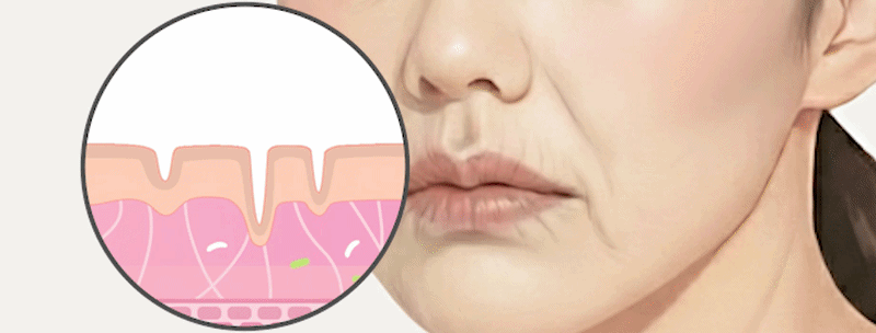 입가주름 리리핏 원리