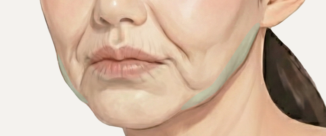 입가 리리핏 솔루션 효과