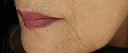 입가 재생주사 복합치료 시술 전