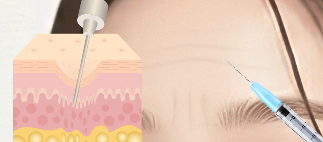 콜라겐 재생 주사