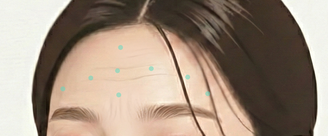 이마 리리핏 솔루션 효과