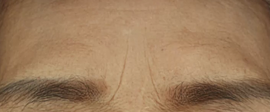 이마 미간 시술 전