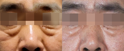 눈가 전후 01