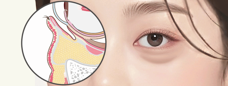 눈밑주름 리리핏 원리