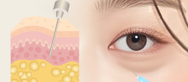 콜라겐 재생 주사