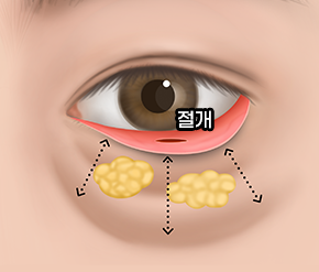 눈밑지방재배치