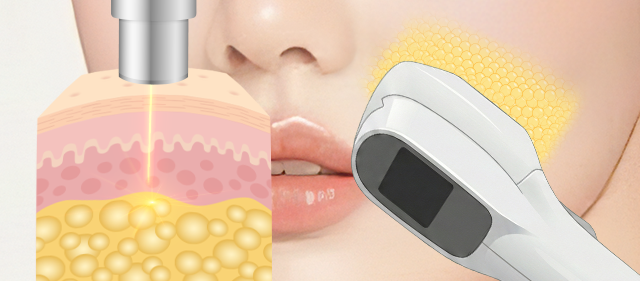 지방축소 레이저
