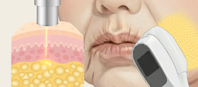 지방축소 레이저