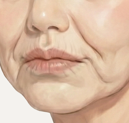 입가 문제 개선