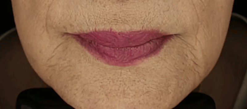 지방축소레이저 시술 부위