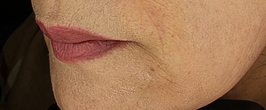 입가 재생주사 복합치료 시술 후