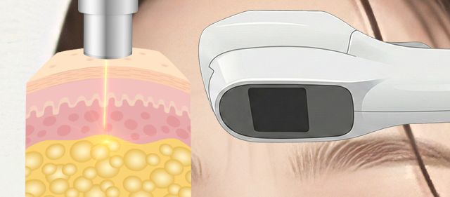 구조축소 레이저