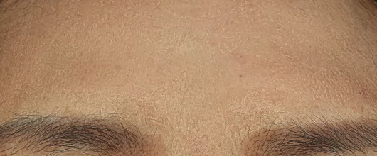 이마 미간 시술 후